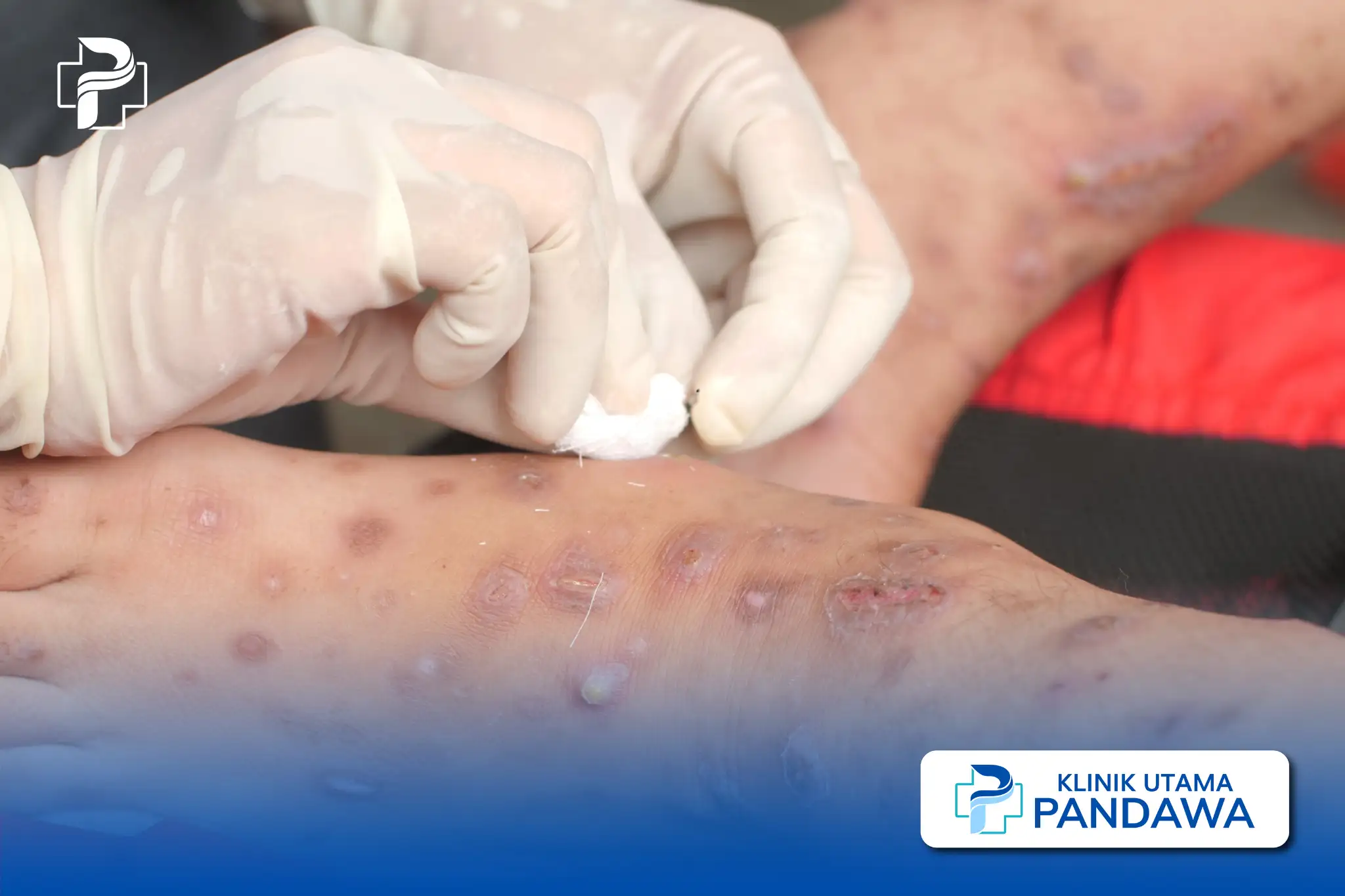 scabies