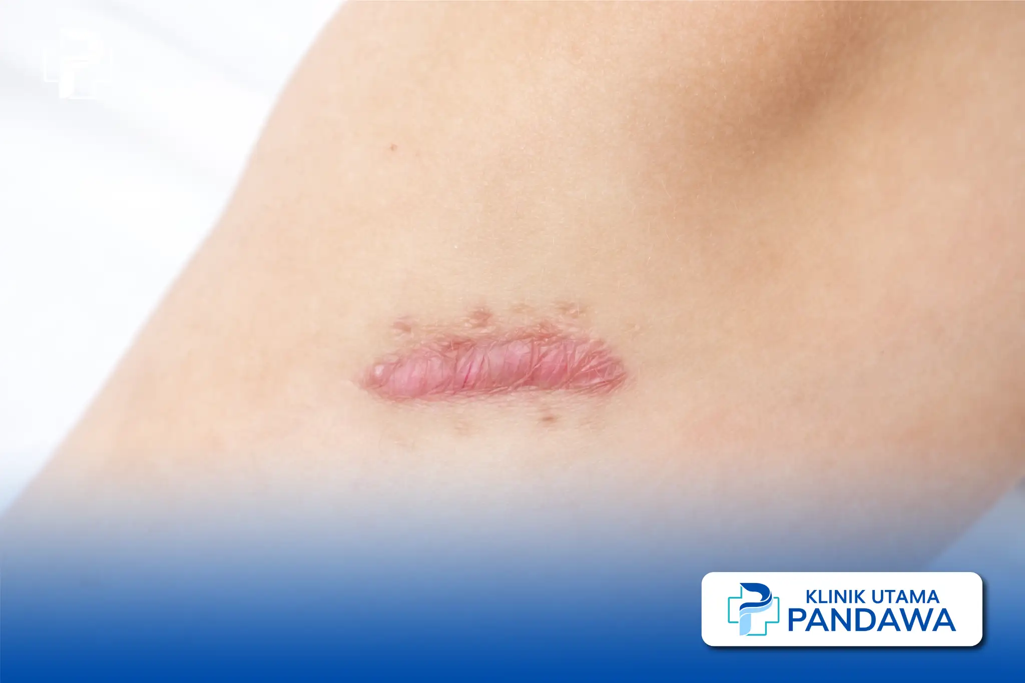 apa itu keloid