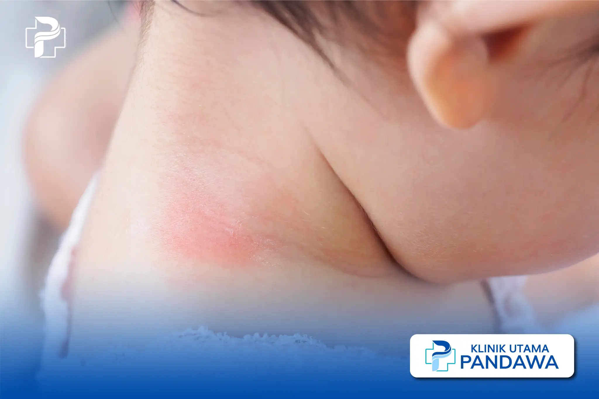bercak merah pada kulit anak tanpa demam