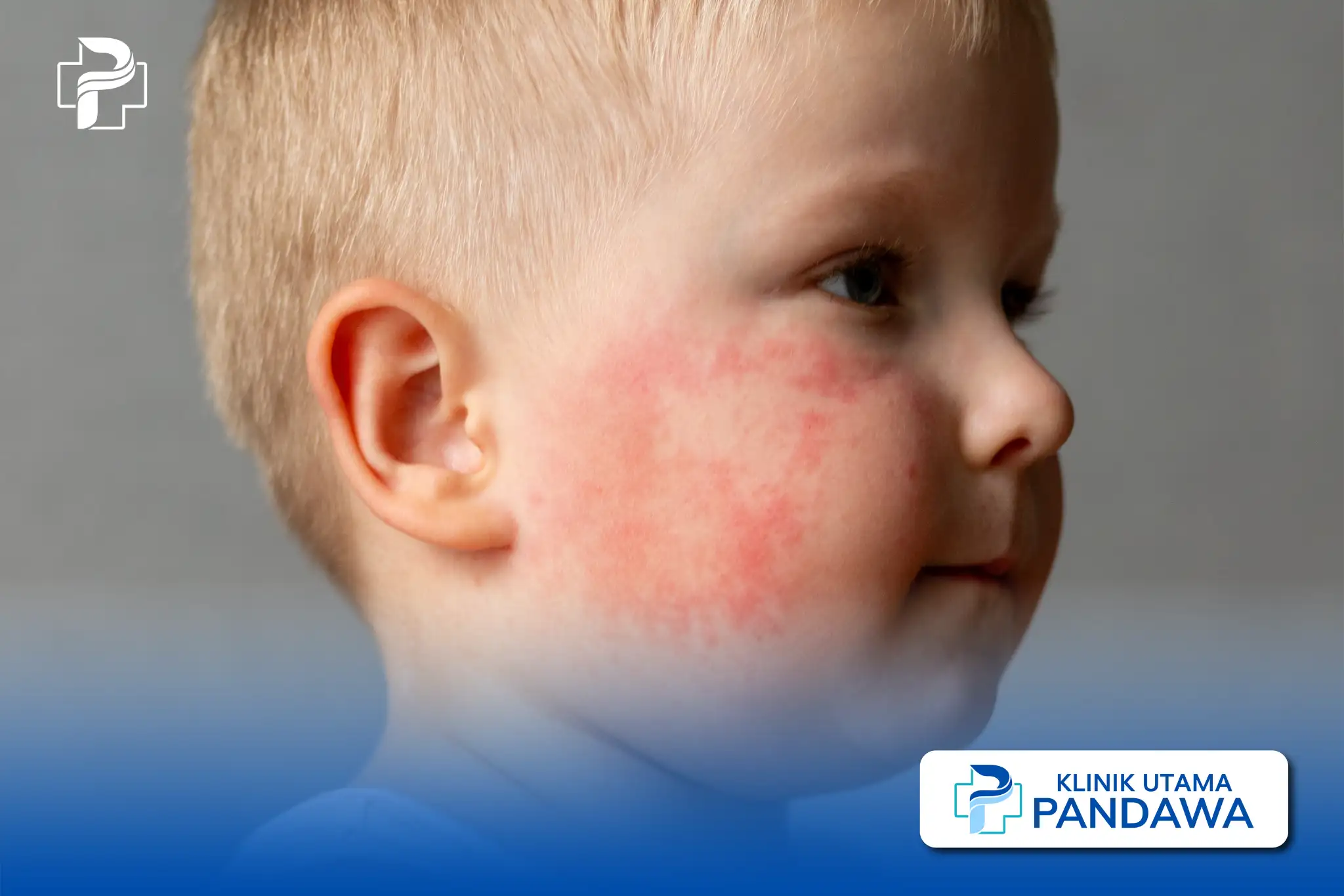 impetigo pada anak