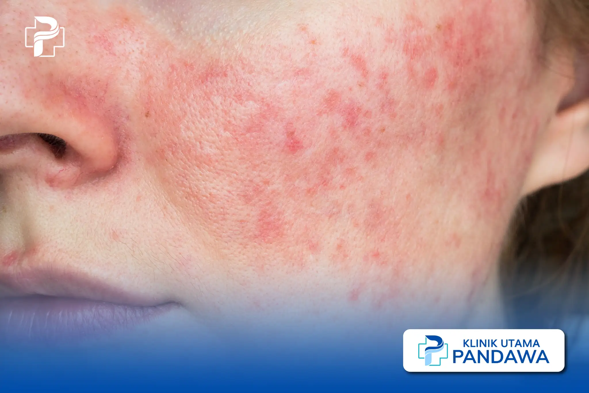 perbedaan rosacea dan jerawat